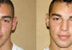 remove your pimples on any photo small2