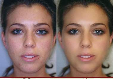 remove acne, scars and other skin impurities from your picture using Photoshop big3