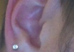 teach you how to get rid of a keloid in your ear