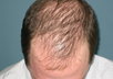 tell you how to prevent balding, stop hair loss and let your hair grow again