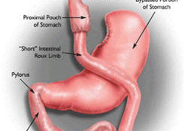 answer any questions you have about Gastric Bypass big1