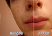remove pimple at your face