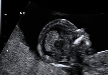 answer questions about your recent or upcoming sonogram big1