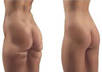 give you liposuction in a photo